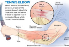 How To Get Rid Of Tennis Elbow f