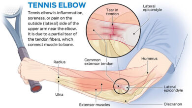 How To Get Rid Of Tennis Elbow f