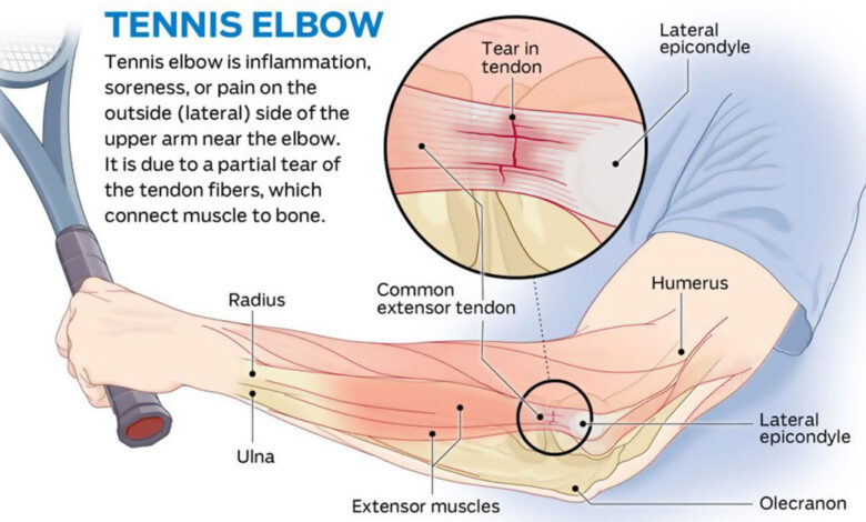 The Ultimate Guide for Tennis Elbow 1 How To Get Rid Of Tennis Elbow f